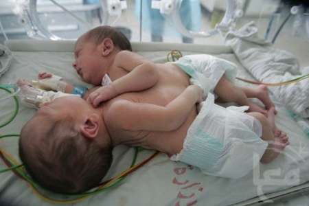 تولد نوزادان دوقلوی به هم چسبیده در شیراز